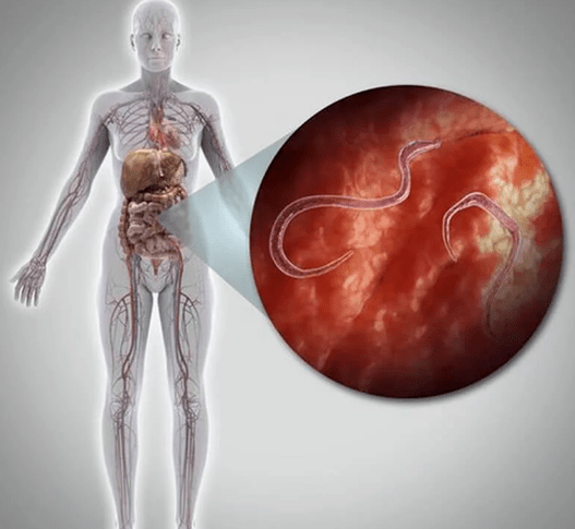 Parásitos en el cuerpo humano