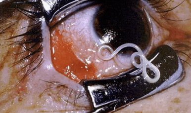 Tipos de parásitos en el cuerpo humano